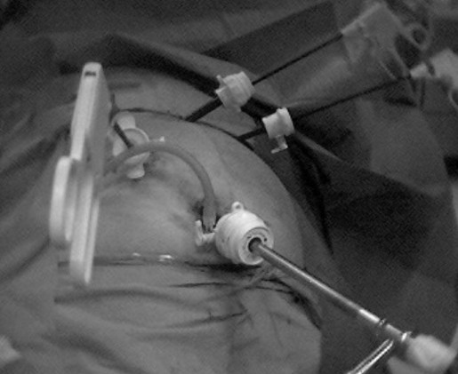 Figure 2: A 10-mm trocar was placed in the mid distance of the umbilicus-xiphoid line. This position permits the laparoscopic grasper to place traction to the infundibulum during the dissection of Calot's triangle and to place clips on the cystic artery and duct that were lying in the normal right of the round ligament position. The laparoscopic dissector was placed in the left midclavicular trocar, and a second grasper was positioned in the anterior axillary line to lift the gallbladder fundus.
