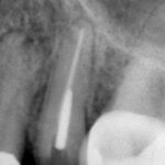 Close-up of a broken tooth at the gum line after root canal treatment
