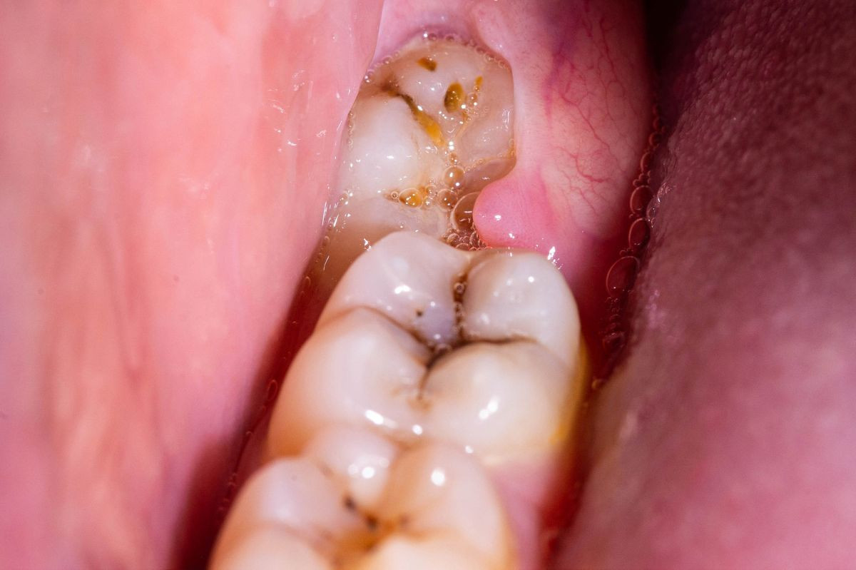 Impacted wisdom tooth causing problems